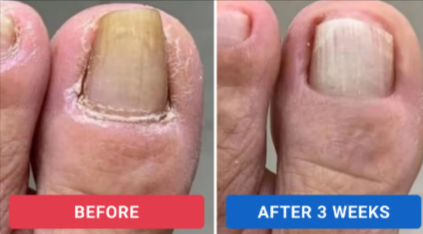 Benefits of Orivelle Fungus Pen